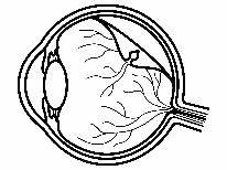 裂孔原性網膜剥離