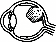 眼の腫瘍